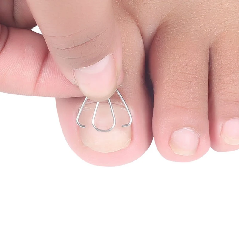 

3Pairs Front nail hook/rubber band Nail Art Ingrown Toe Nail Correction Toenail Nail Ingrown Clip Orthosis Paronychia Pedicure
