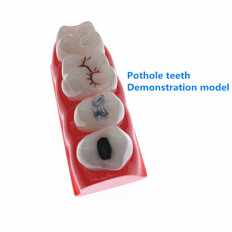 Демонстрационная модель герметика и инкрустации кариеса зубных протезов|dental model
