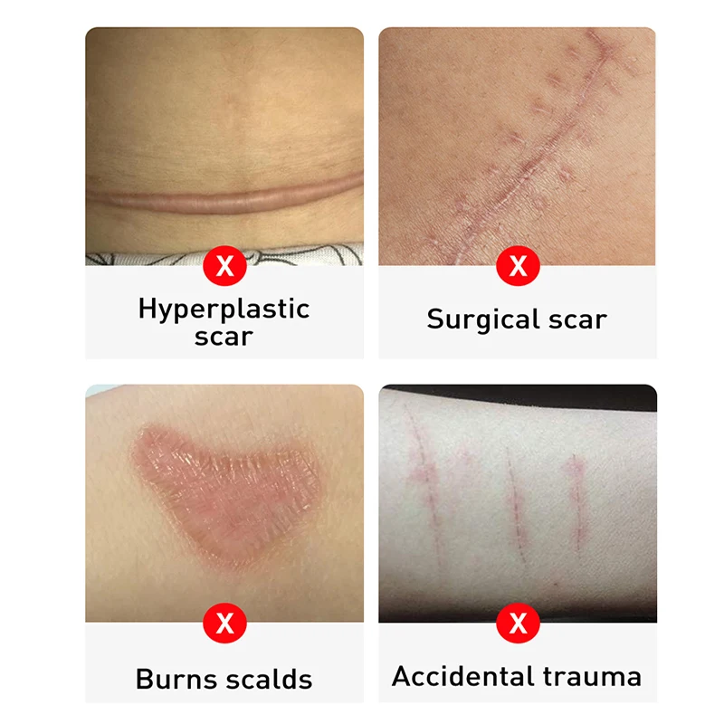 Крем LANBENA для удаления шрамов и угрей отбеливающий 30 мл | Красота здоровье