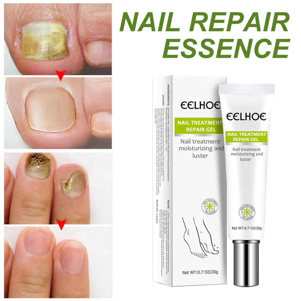 

20g Nail Repair Gel for Finger Toe Nails Nail Strengthener Recovery for Cracked Weak Broken Damaged Treat various nail problems