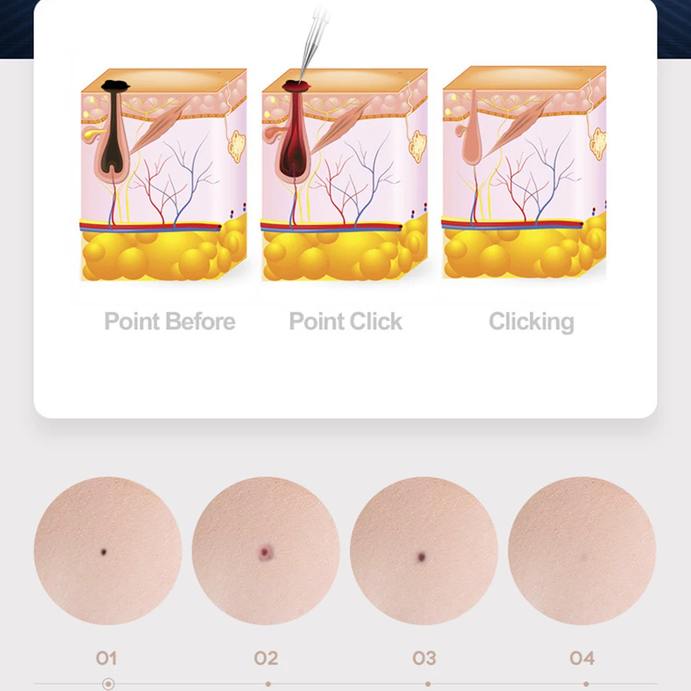 Плазменная ручка плазменная для удаления бородавок моль тату Машинка метка на