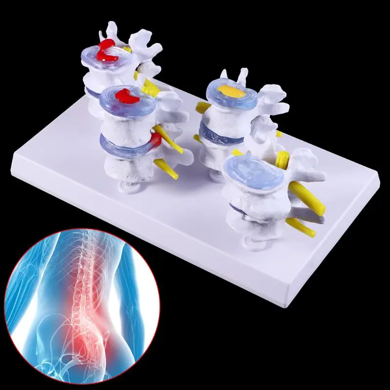 

1 Set Human Lumbar Lesion Spine Statue Display Model Teaching Learning Tool M5TE