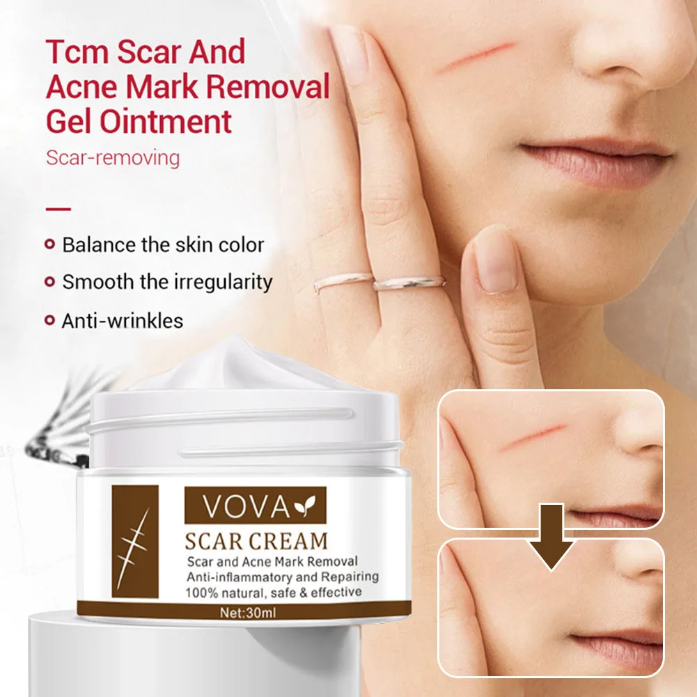 

30ml Scar Removal Cream Acne Spots Treatment for Burns Acne Marks Pimples Scars Injury Surgery Scar Remover for Face Body