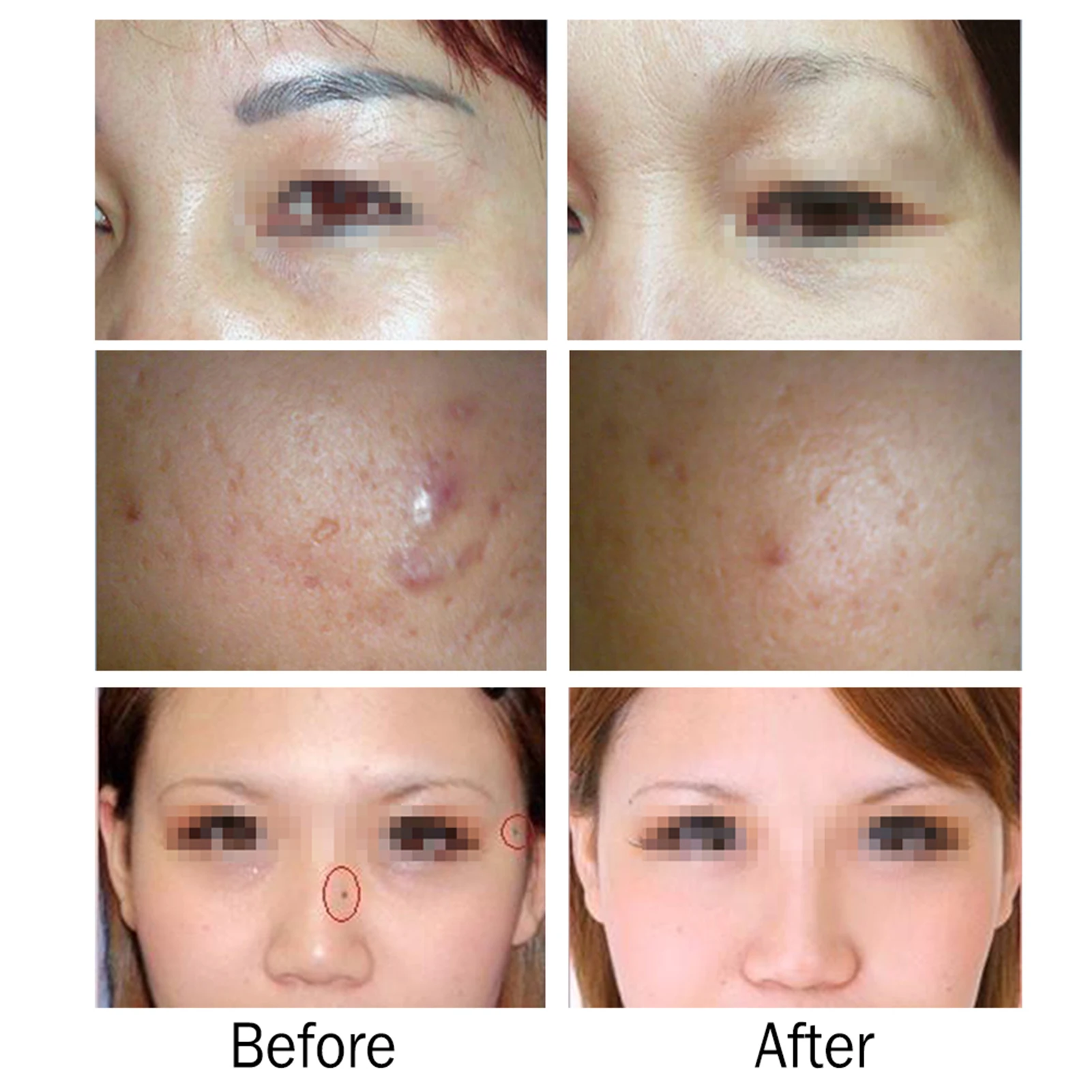 Лазерная ручка Picosecond для световой терапии устройство удаления пятен и веснушек