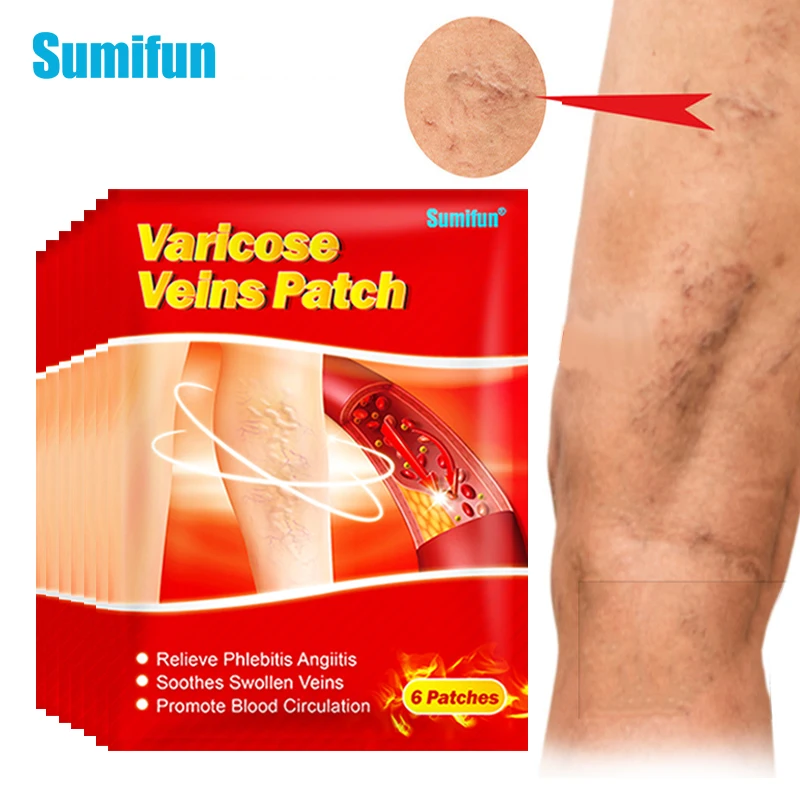 

6/18/36Pcs Varicose Veins Plaster Treatment Angiitis Spider Leg Vasculitis Phlebitis Care Removal Patch Medical Herbal Sticker