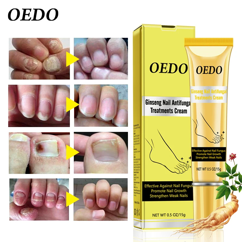 Herbal Fungal Nail Treatment Ginseng Antifungal Treatments Cream Removal Repair Essence Onychomycosis Foot | Красота и здоровье