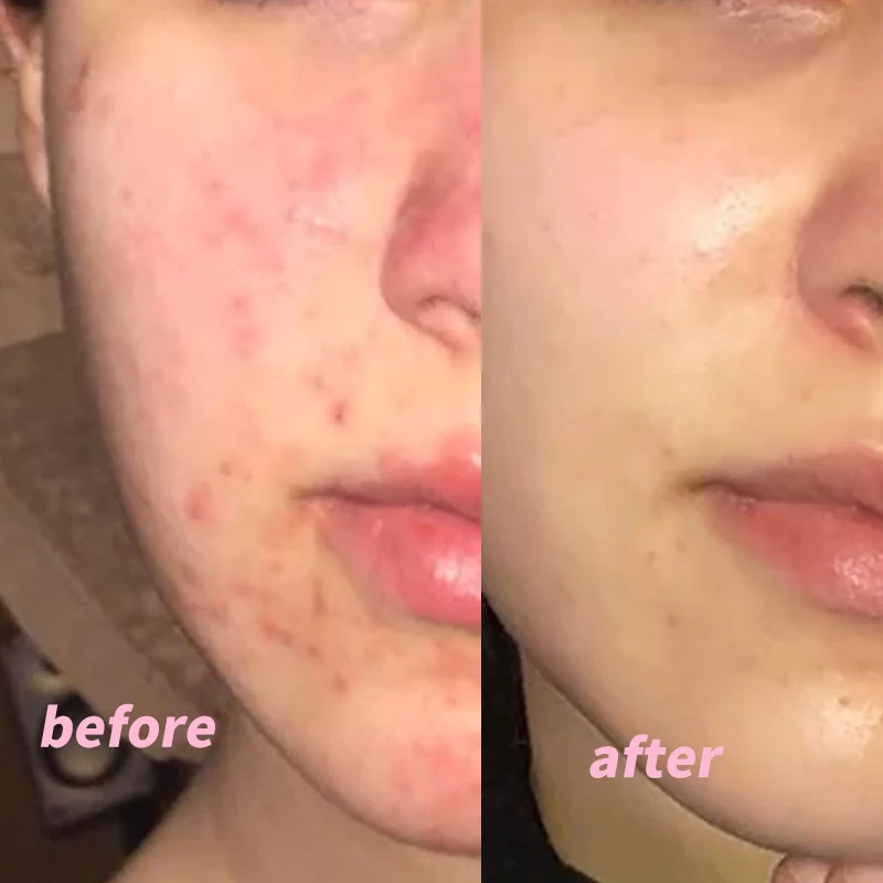 

Clearwin Gel Clin & Nicotinamide Gel For Acne Treatment 15g