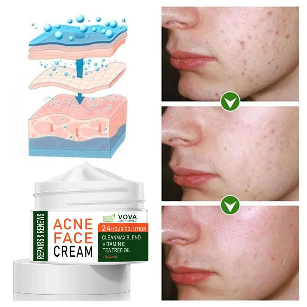 

Effective Acne Removal Cream Acne Treatment Fade Acne Whitening Care Shrink Spots Oil Cream Control Skin Pores Acne Moistur U8K5