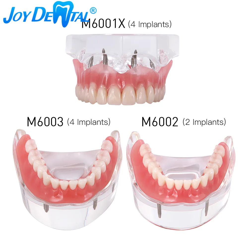

Dental Implant Teeth Model Demo Overdenture Restoration Clear With 2/4 Implants Upper Maxillary Lower Mndibular