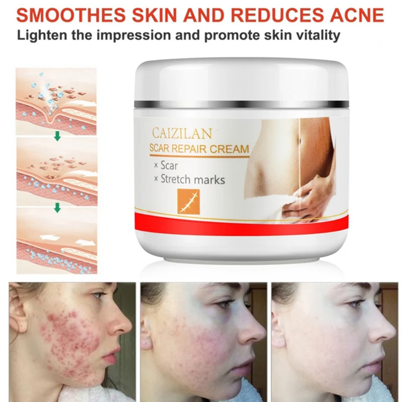 30g Acne Scar Stretch Marks Repair Cream Removal Spots Blackhead Whitening Skin For Scald Marks Skin Smoothing Scar Repair Cream