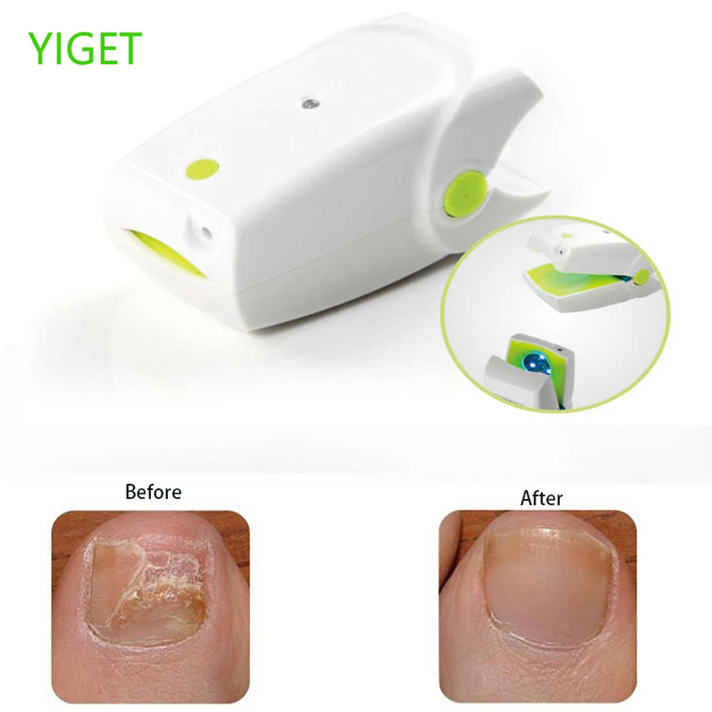 Перезаряжаемое устройство для лечения грибка ногтей онихомикоза