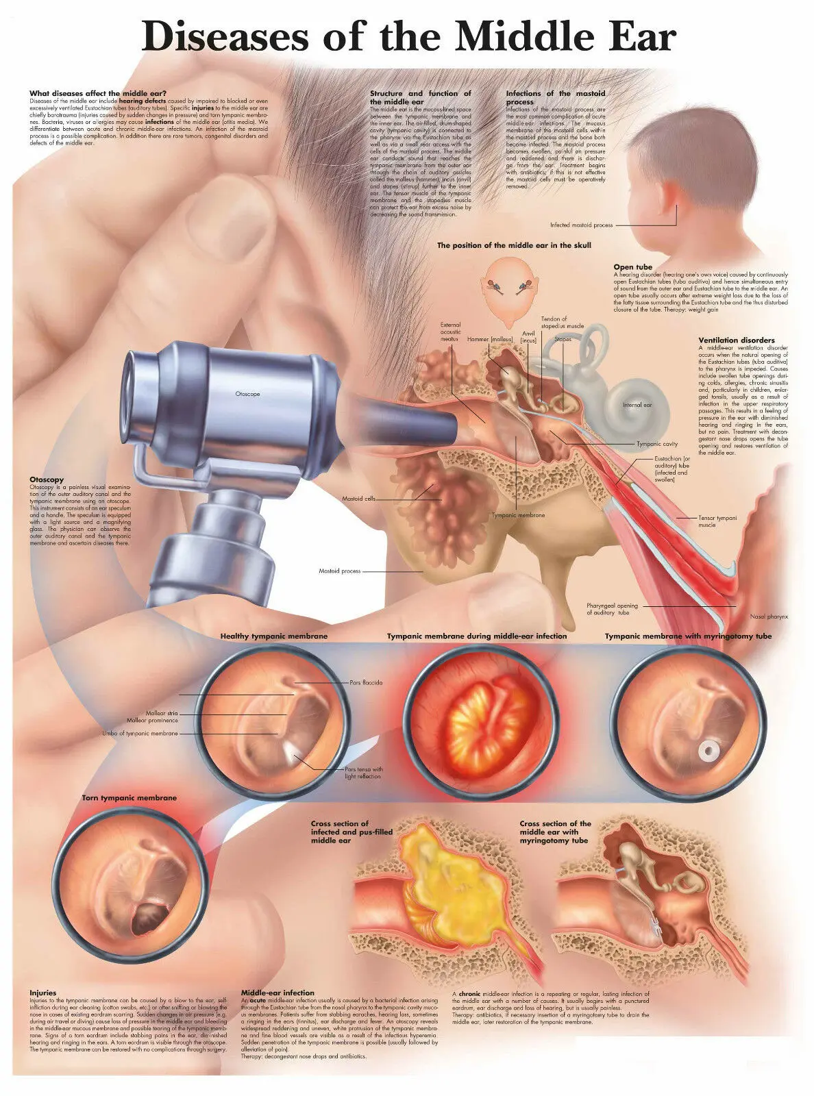 

Diseases of the Middle Ear Picture Art print Silk poster Home Wall Decor