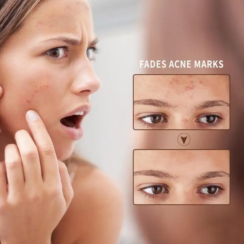 Успокаивающая мышц гель алоэ вера лосьон капсулы увлажняющее масло от акне крем