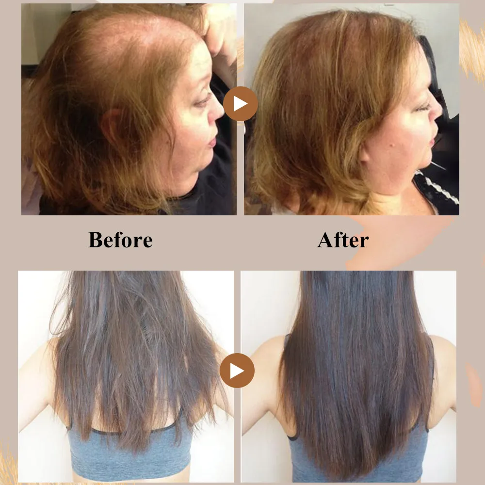 2 шт. сывороточная эссенция для быстрого роста волос масло против выпадения уход