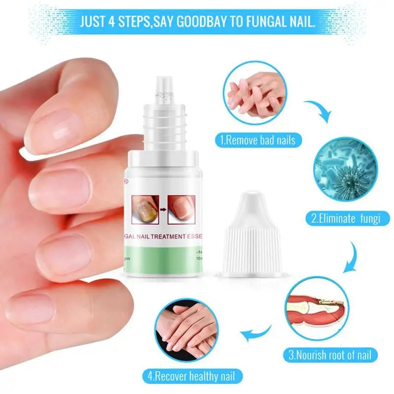 

10ml Nail Care Solution Antifungal Treatment For Hyperthyroidism Care Formula Solution Infection Herbal J9R0