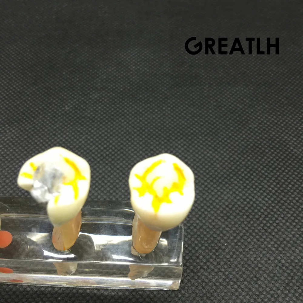 Стоматологическая 5 ступенчатая модель для эндодотического лечения корневых