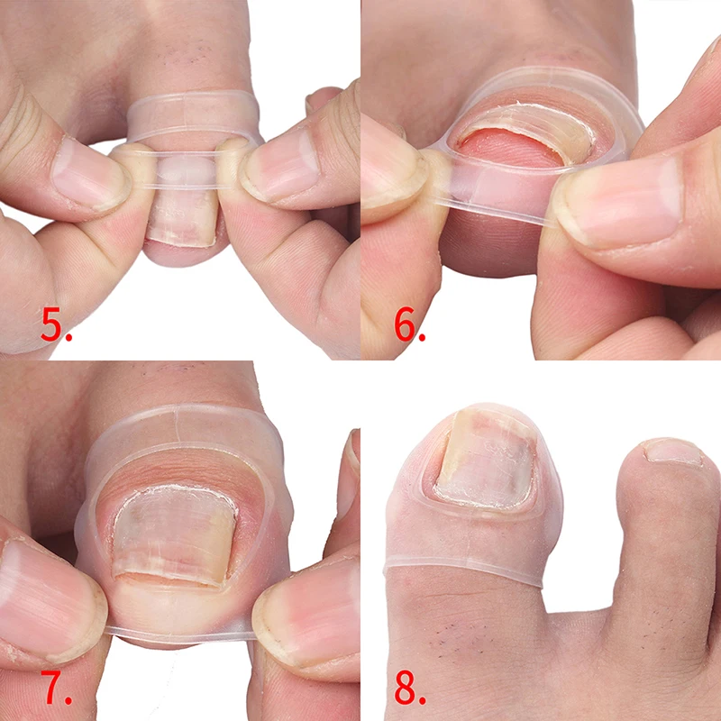 

1Pair Silicone Invisible Ingrown Toenail Correction Tool Toe Nail Treatment Elastic Straightening Clip Brace Pedicure Tool New