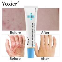 yoxier 20g herbal antibacterial cream psoriasis cream anti itch relief eczema skin rash eczema urticaria desquamation treatment