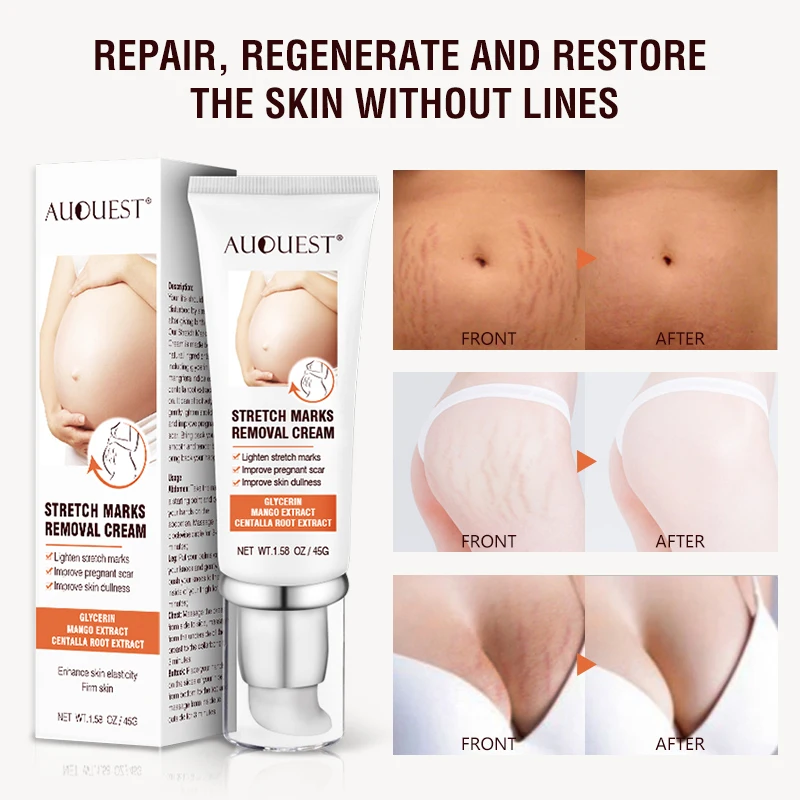 

Pregnancy scar removal acne cream anti-aging anti-wrinkle firming body cream stretch mark treatment maternal repair 45g
