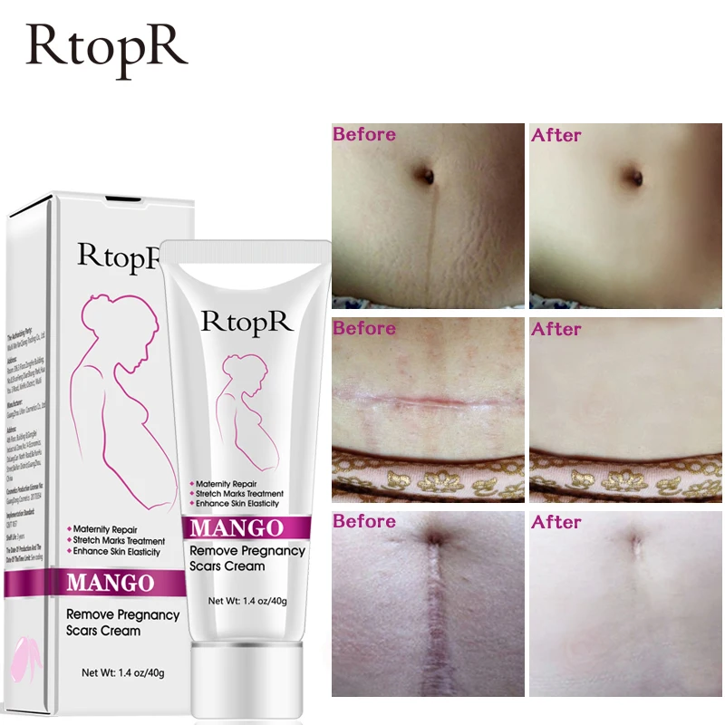 Крем для беременных манго удаляет шрамы уменьшает морщины защищает кожу женщин
