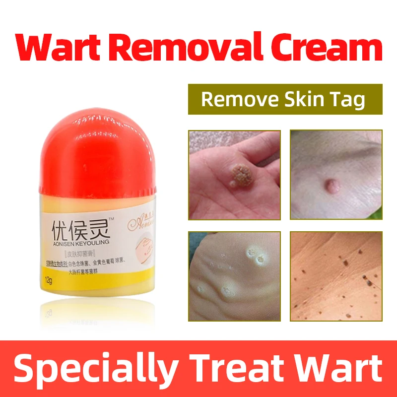 

Мазь для удаления бородавок на теле, медицинский крем для удаления мозолей на ногах, боли в коже