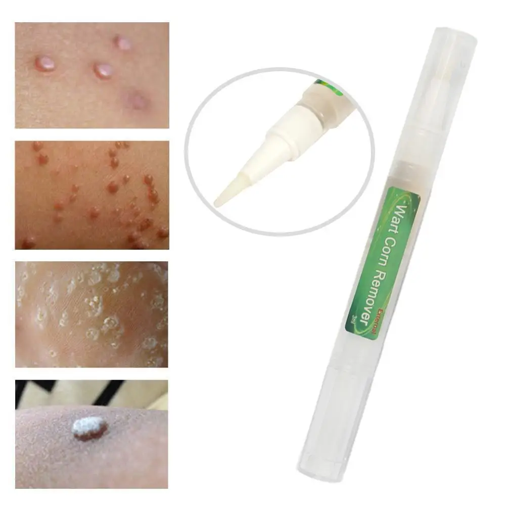 

Genital External Wart Corn Remover 3ml Treatment Papillomas Removing Warts Removal Moles N7X7