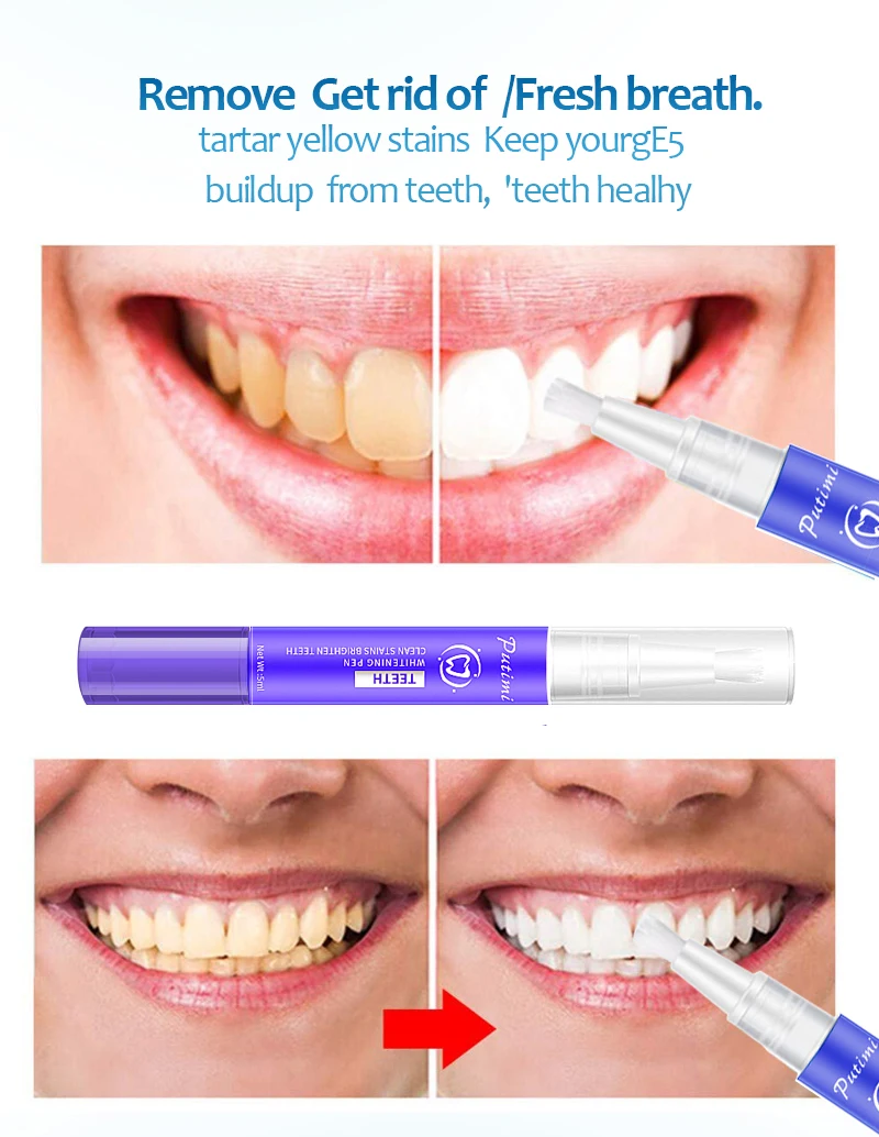 Отбеливающая ручка для зубов Putimi сыворотка удаления зубного налета средство