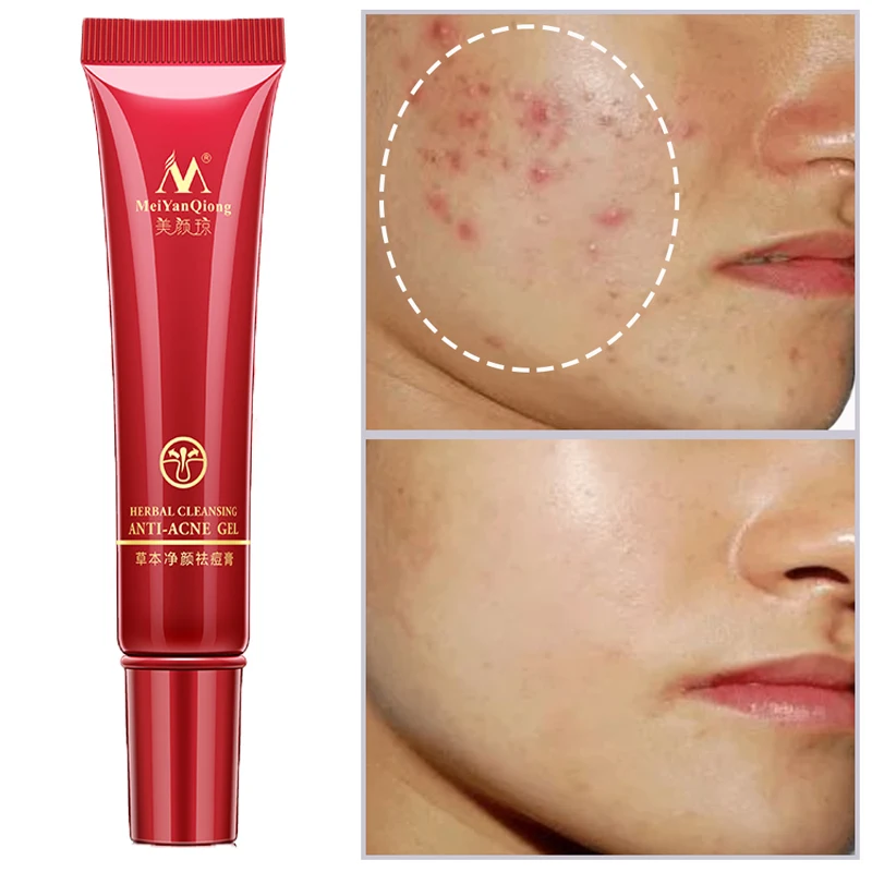 

Instant Acne Removal Cream Herbal Anti-acne Repair Fade Acne Spots Face Gel Oil Control Whitening Moisturizing Facial Skin Care