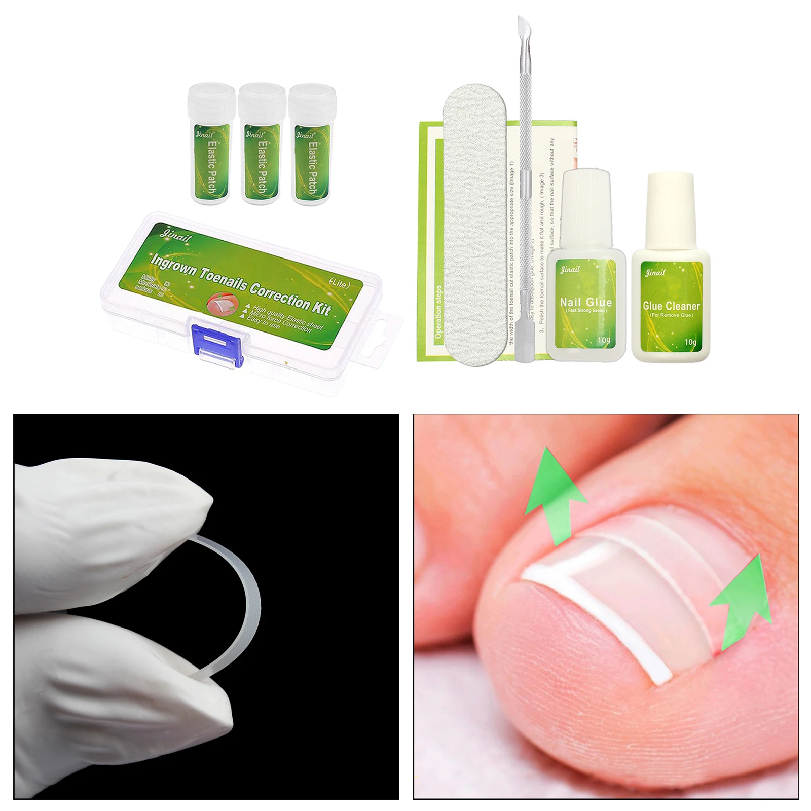 

Ingrown Toenail Correction Kit Straightening Patch Pusher Recover Foot Care Tool