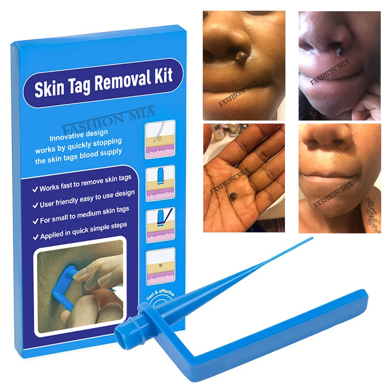 

Medical Skin Tag Kill Skin Mole Wart Remover Micro Band Skin Tag Removal Kit With Cleansing Swabs Adult Mole Wart Face Care Tool