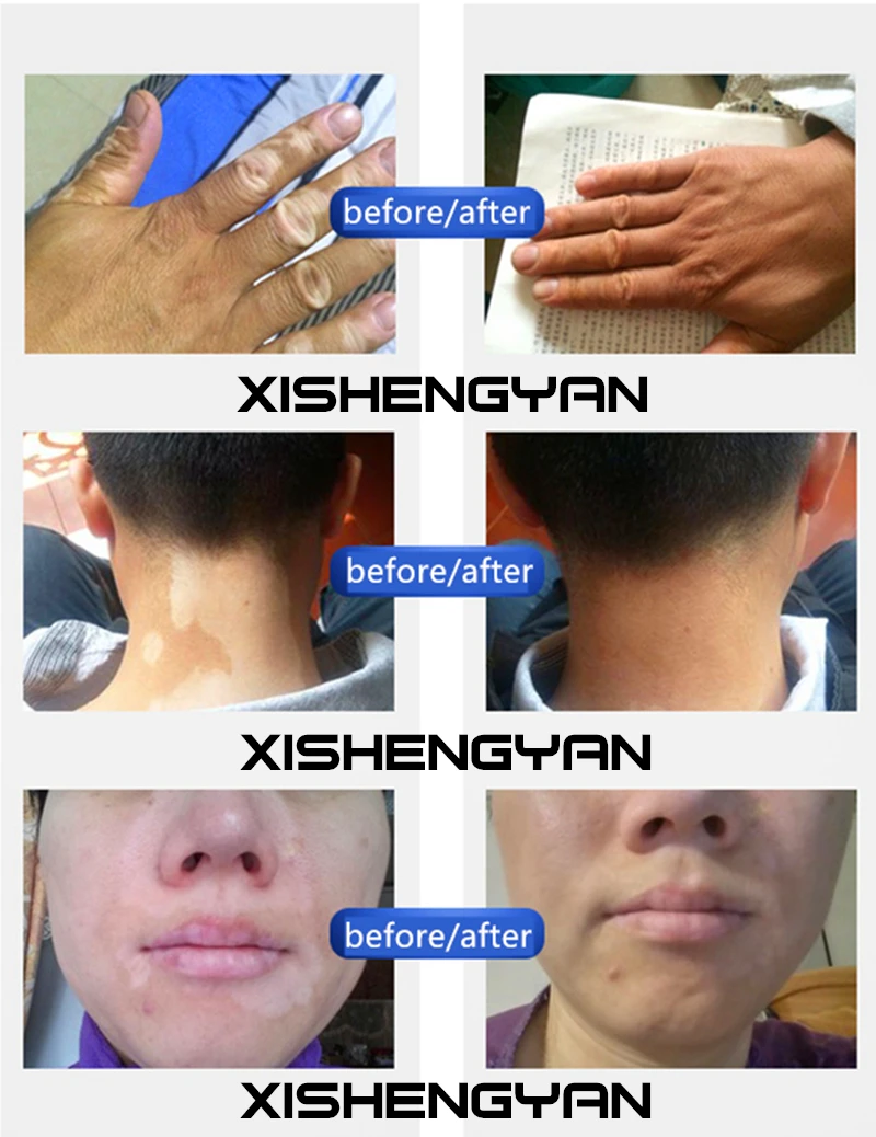 Чехол vitilgo патчи водонепроницаемый мгновенный кожи Leucoderma макияж покрытие консилер ручка на лицо руки тела для женщин мужчин детей 1 шт