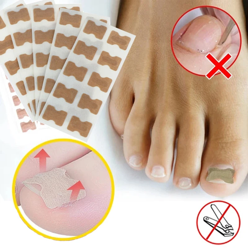 

5 pieces of 50 stickers toenail nail ingrowth correction sticker foot care paronychia correction