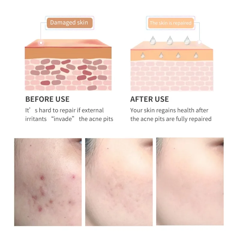 

Acne Scar Removal Gel Fade Acne Marks Spots Remove Skin Pigmentation Soothing Prevent Acne Treatment Serum Essence 30g