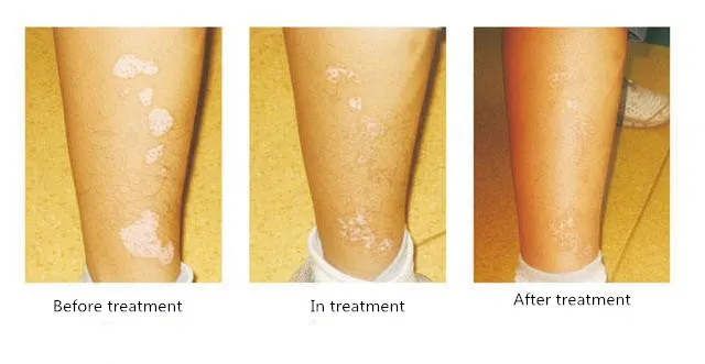 

White spot antibacterial cream external topic cream white spot cream 30g Bacteriostasis