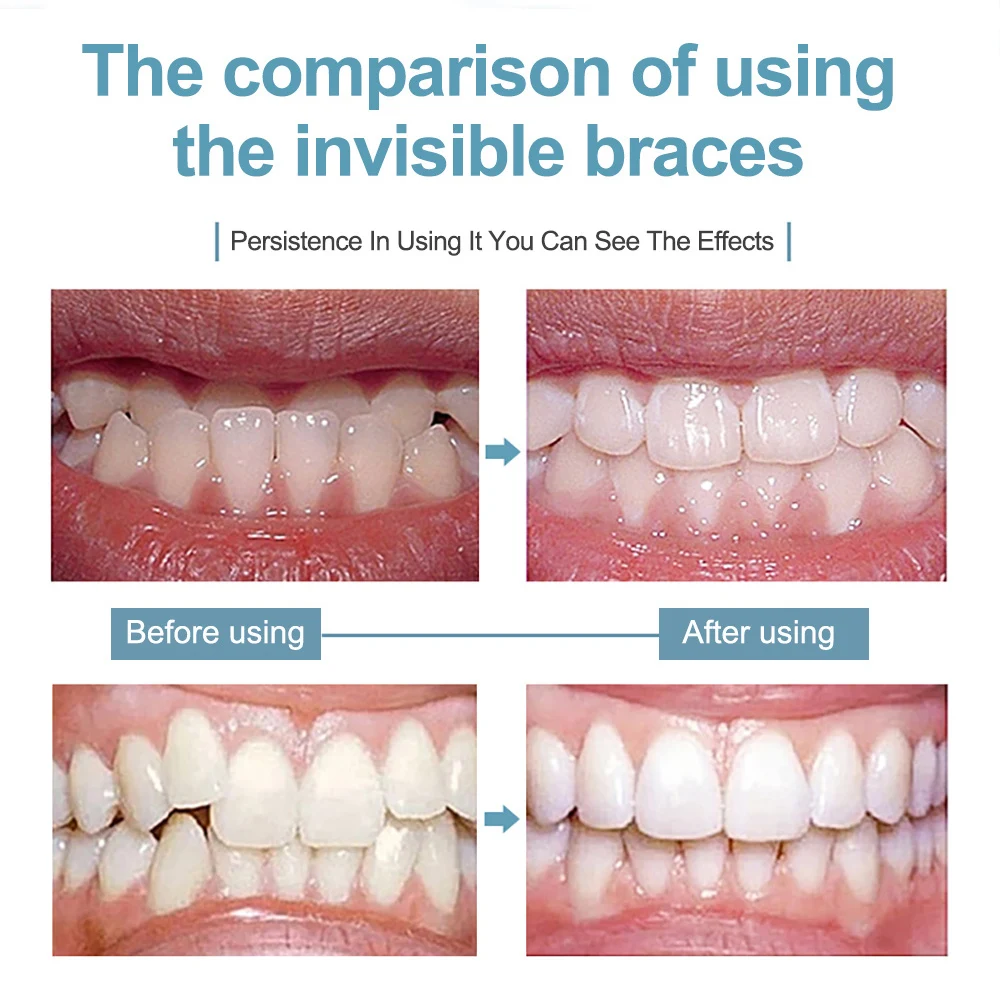 Cofoe Dental Braces Orthodontic locator Invisible orthodontic bracket For Smile Teeth Alignment Trainer and dental care With box