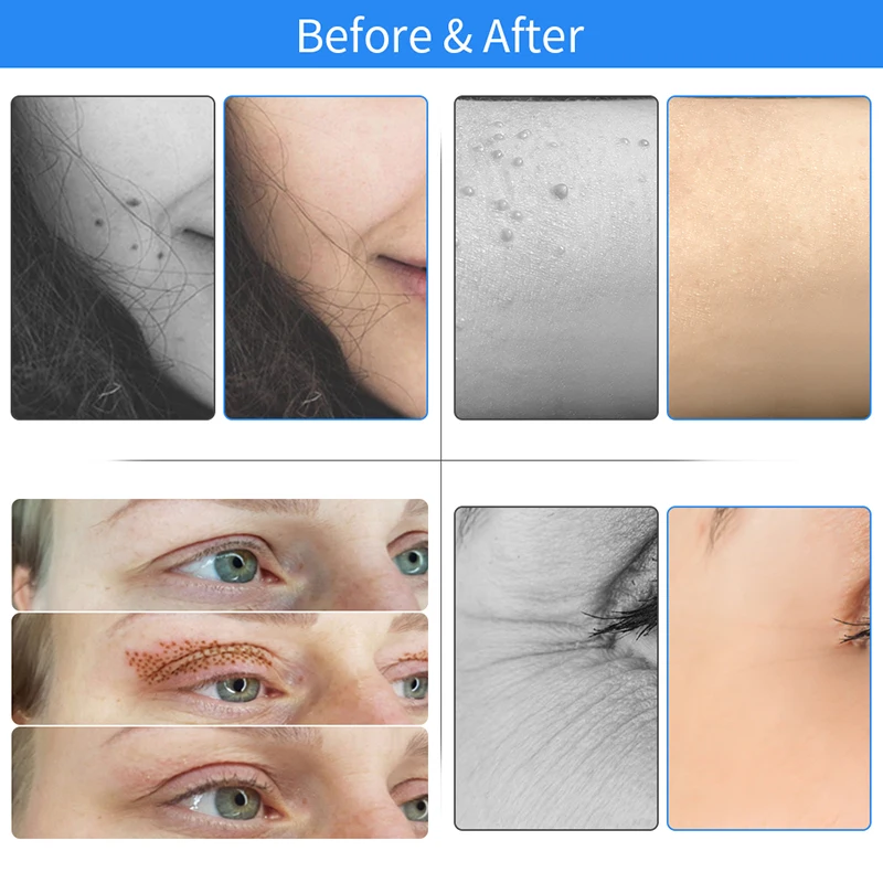 

Maglev Plasma Pen Eyelid lifting Pen Laser Plasma Tattoo Freckle Dark Spot Remover Wart Removal Beauty Machine