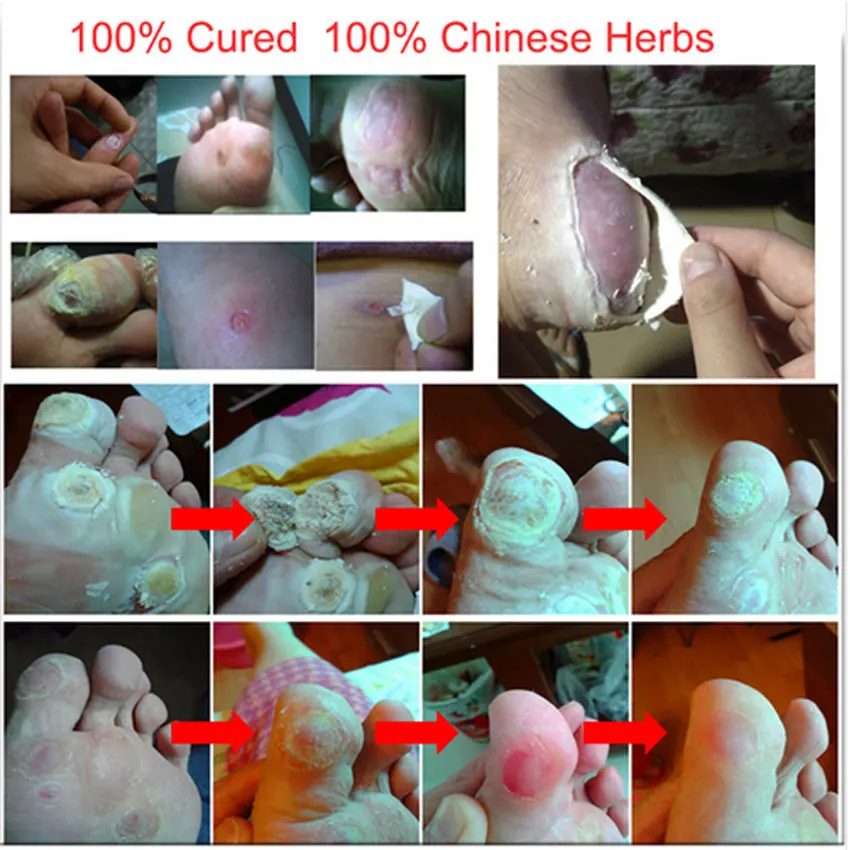 Chinese Medicine Treatment Foot Corn Removal Plantar Warts Pomada De Verruga Care Medical Plaster Ointment | Красота и здоровье