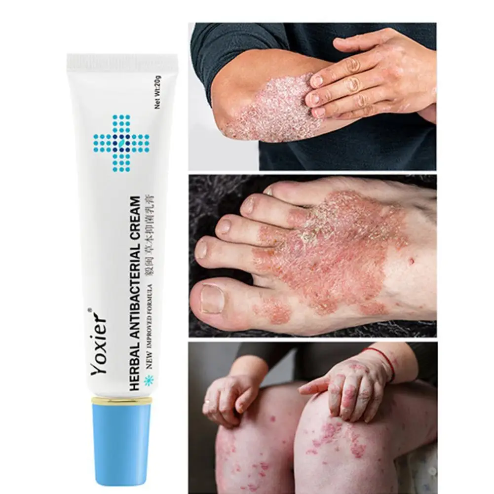 

Herbal Antibacterial Cream Psoriasis Cream Anti-itch Treatment Desquamation Relief Eczema 20g Skin Rash Urticaria T3C0