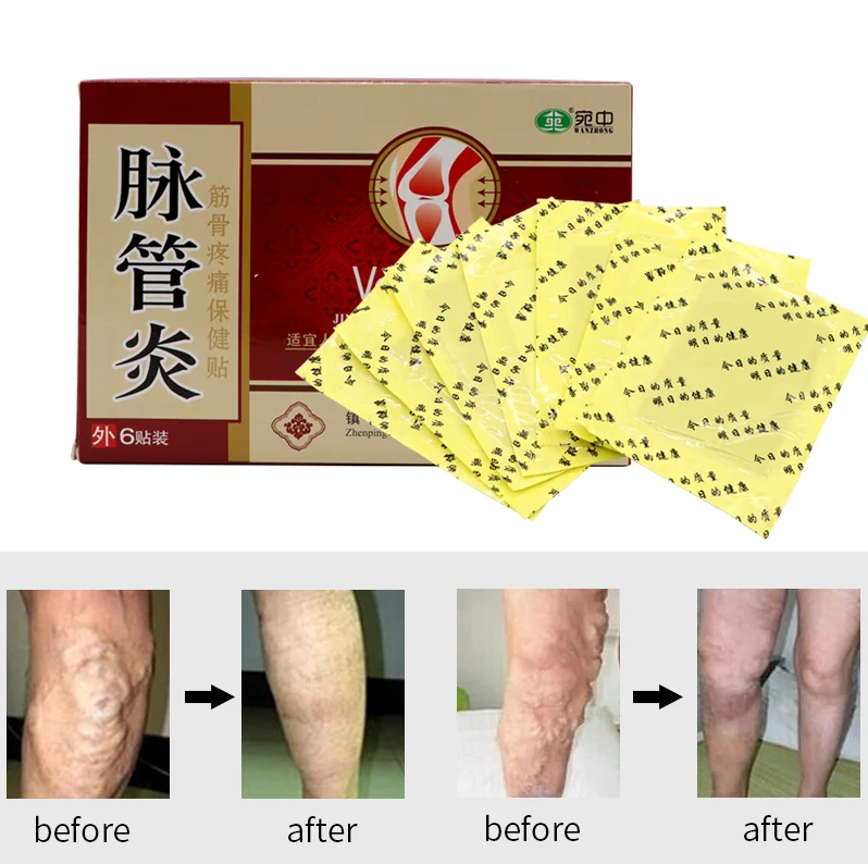 

24PCS Spider Veins Varicose Treatment Plaster Varicose Veins Cure Patch Vasculitis Natural Solution Herbal Patches