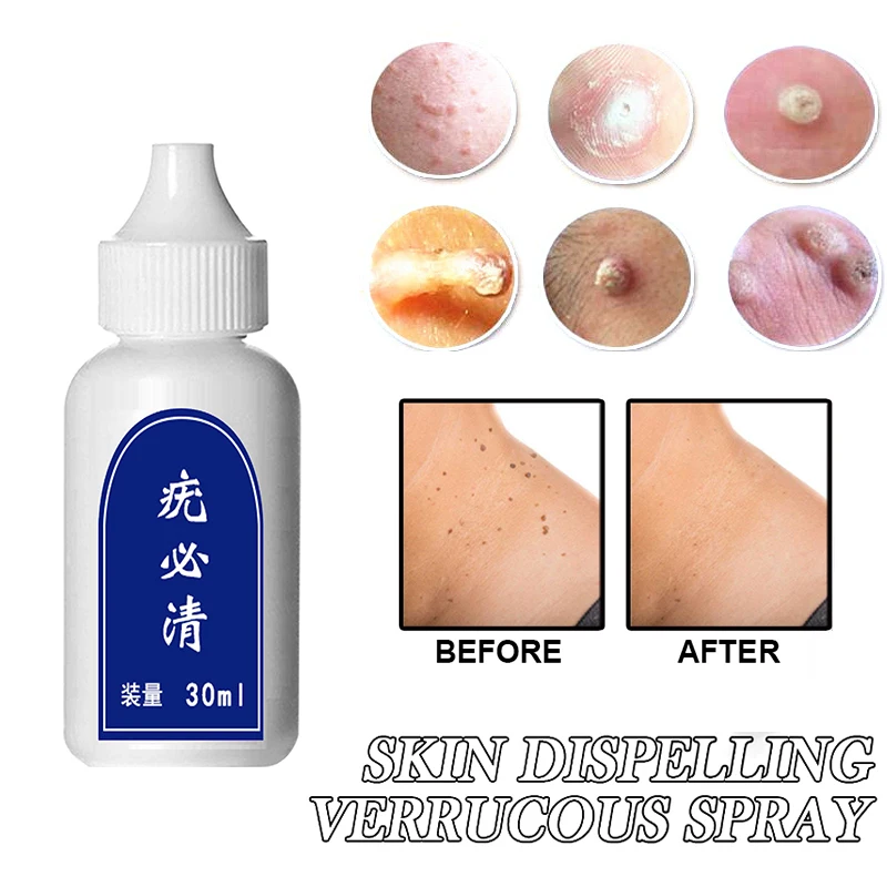 Бирка для удаления бородавок на коже средство лечения гениталий родинок и