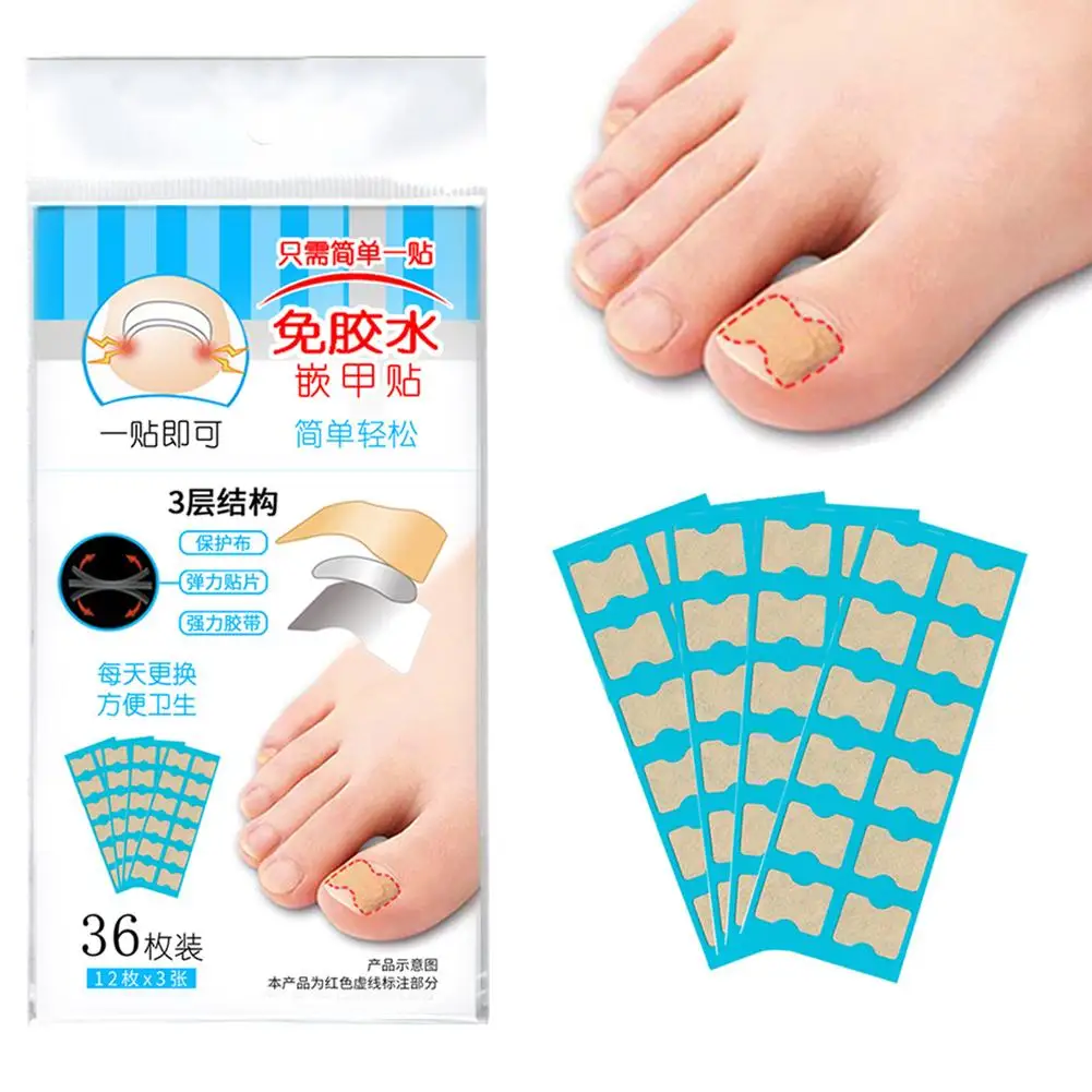 36/72 шт. коррекция вросших ногтей | Красота и здоровье