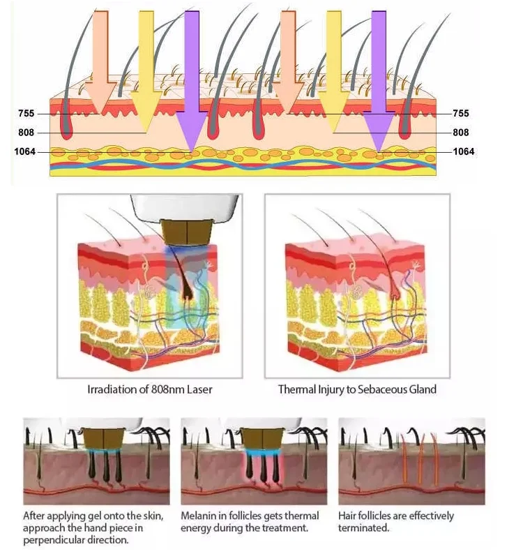 

Hottest 20 million Shots 808nm Diode Laser Hair Removal Machine 808 Diode Laser Hair Remvoal beauty machine remove hair