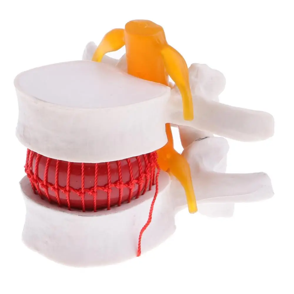 Человеческая медицинская анатомическая спина поясница дисковая грыжа