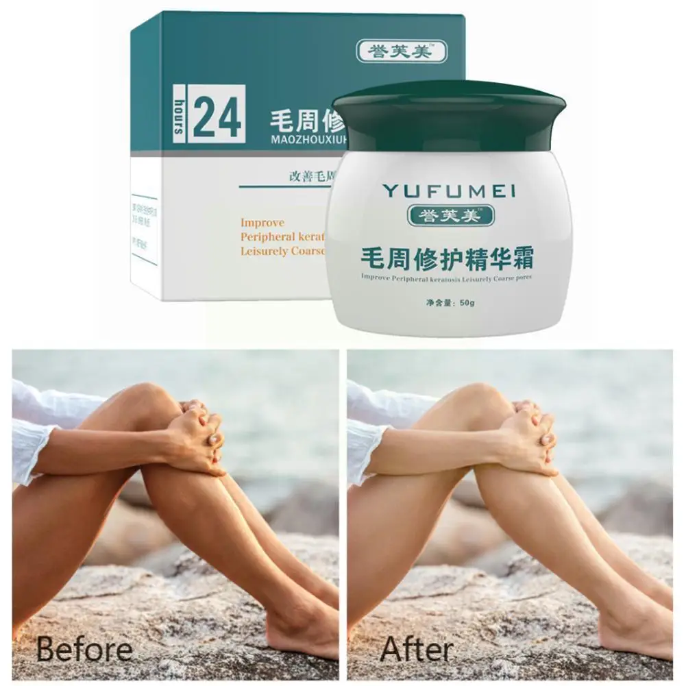 

50g Moisturizing And Nourishing Essence Curing Keratosis Pilaris/ Skin Cream Body Chicken Repair Kp/ Care Lotion Skin Skin C9w0