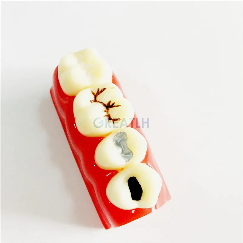Модель для обучения стоматологии и уплотнению трещин зубов|tooth teeth|dental toothdental model