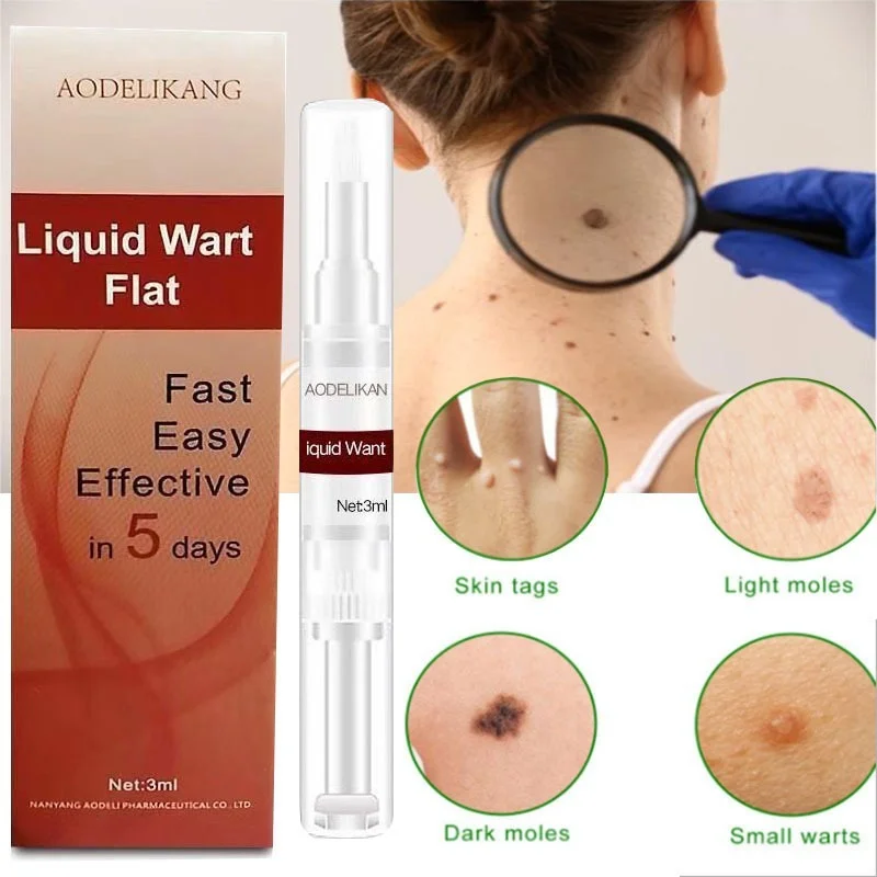 

Ke Wart Liquid Pen Corns Flat Plantar Wart Removing Youzi Pen Wart Liquid Pen Fleshy Flat Warts Filiform Warts Oem