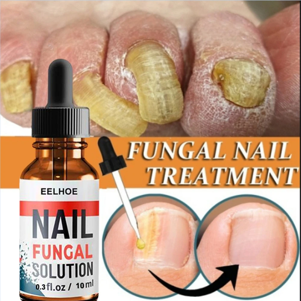 

30ml Onychomycosis Paronychia Anti-Fungal Nail Infection Herbal Toe Fungus Foot Repair Essence Care Fungal Nail Treatment Serum