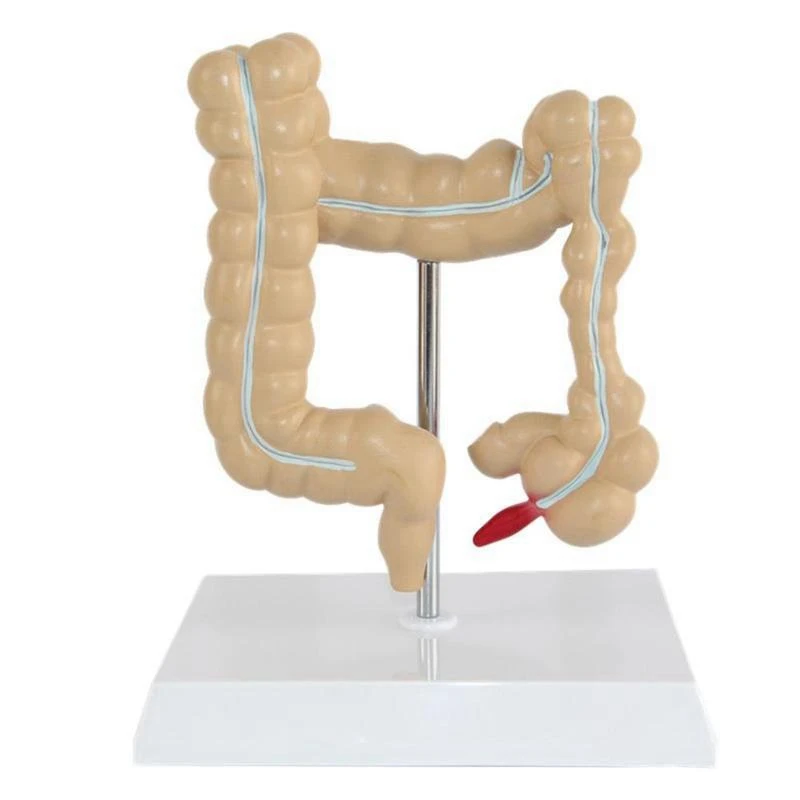 Colorectal Lesion Model Human Colon Large Intestine Pathological Diseases Medical Mrganizer Anatomy |