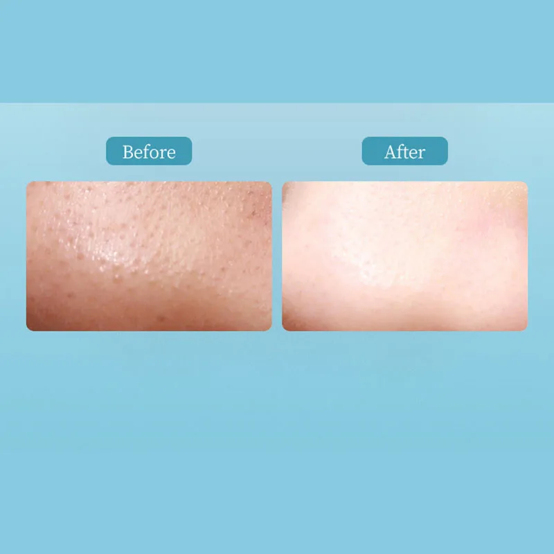 

Blackhead Remover Face Deep Nose Cleaner T Zone Pore Acne Pimple Vacuum Suction Facial Beauty Clean Skin Tool