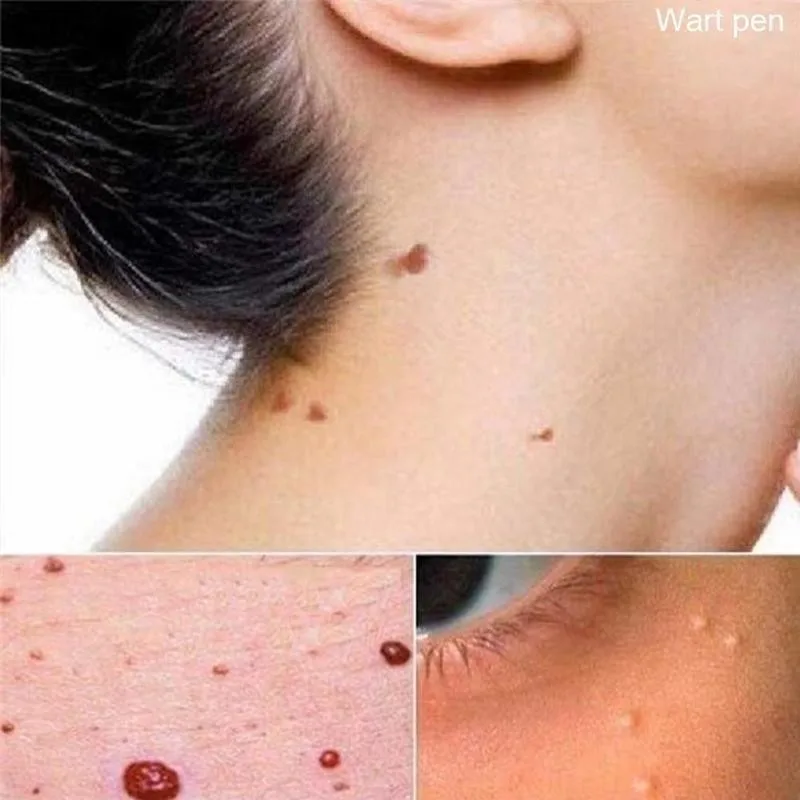 3ml Wipe Off Tags &amp Moles Pen For Callus Gram Warts Foot Remover Liquid Genital Wart Removal Treatment Skin Beauty | Красота и